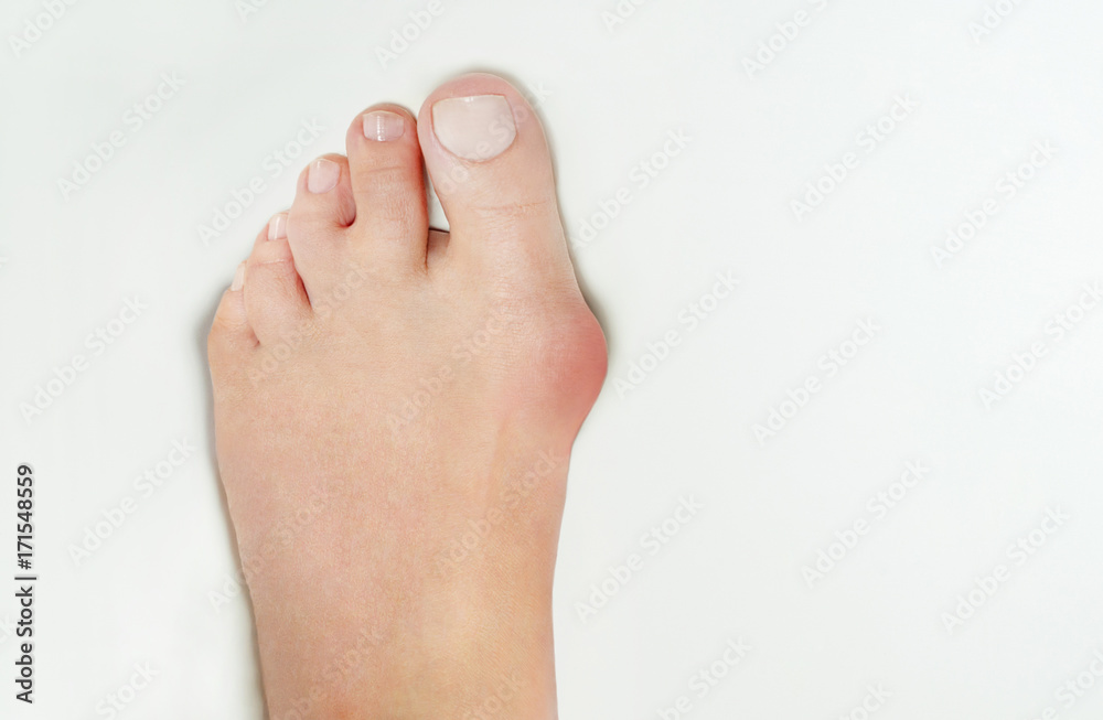 Hallux valgus, bunion in foot on white background Hallux valgus, bunion in foot on white background