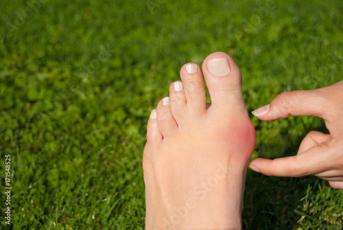 Hallux valgus, bunion in foot on grass background © luaeva