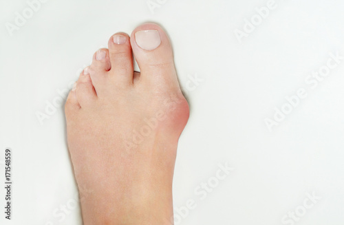 Hallux valgus, bunion in foot on white background