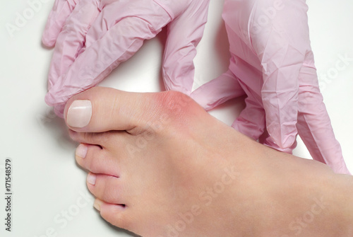 Hallux valgus, bunion in foot on white background photo