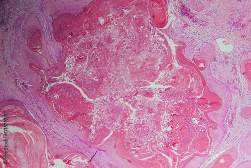 human cells, well differentiated squamous cell carcinomas photo