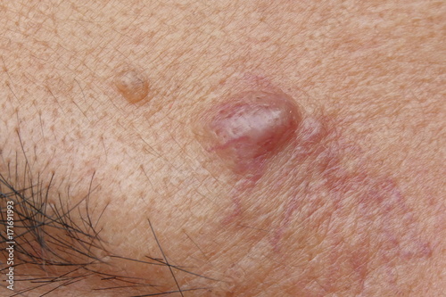Close-up cyst on a human face photo