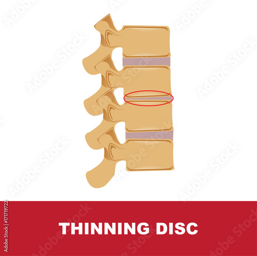 human disc degeneration. thinning disc vector illustration