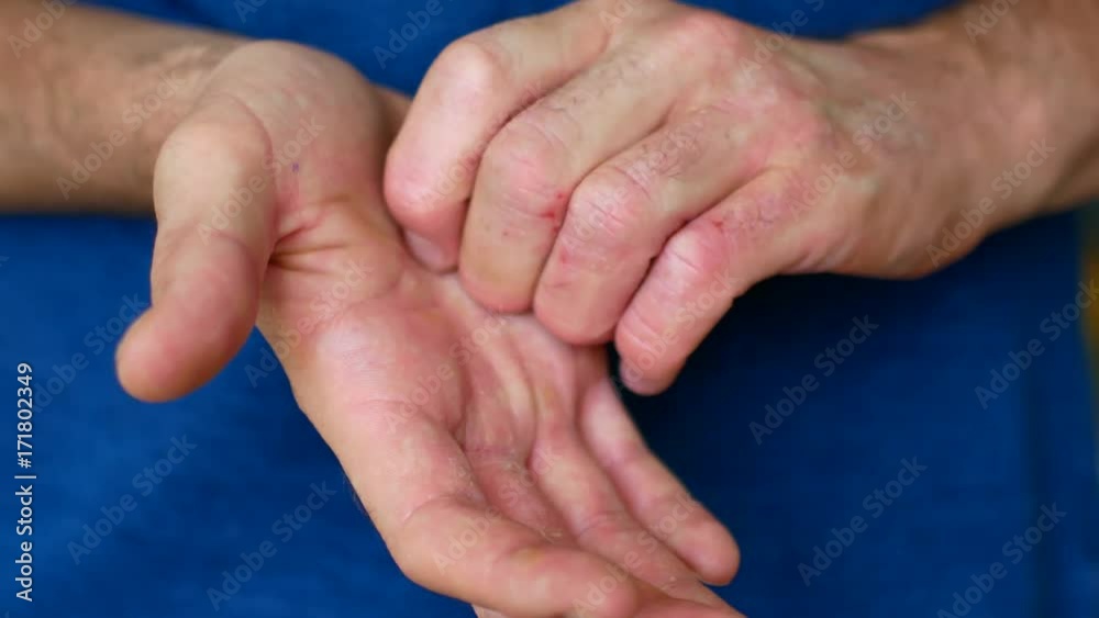 The man has psoriasis. The man is nervous and scratches his hands. The man has psoriasis. The man is nervous and scratches his hands.