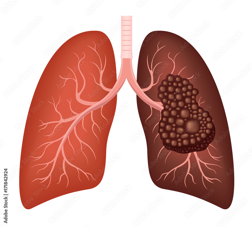 healthy lung and cancer lung vector Stock Vector | Adobe Stock