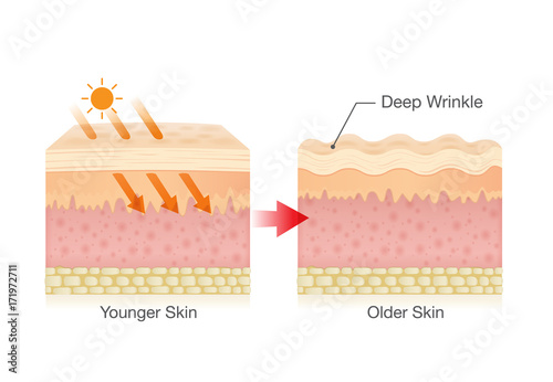 Sunlight makes sagging skin and makes it appear more wrinkled.