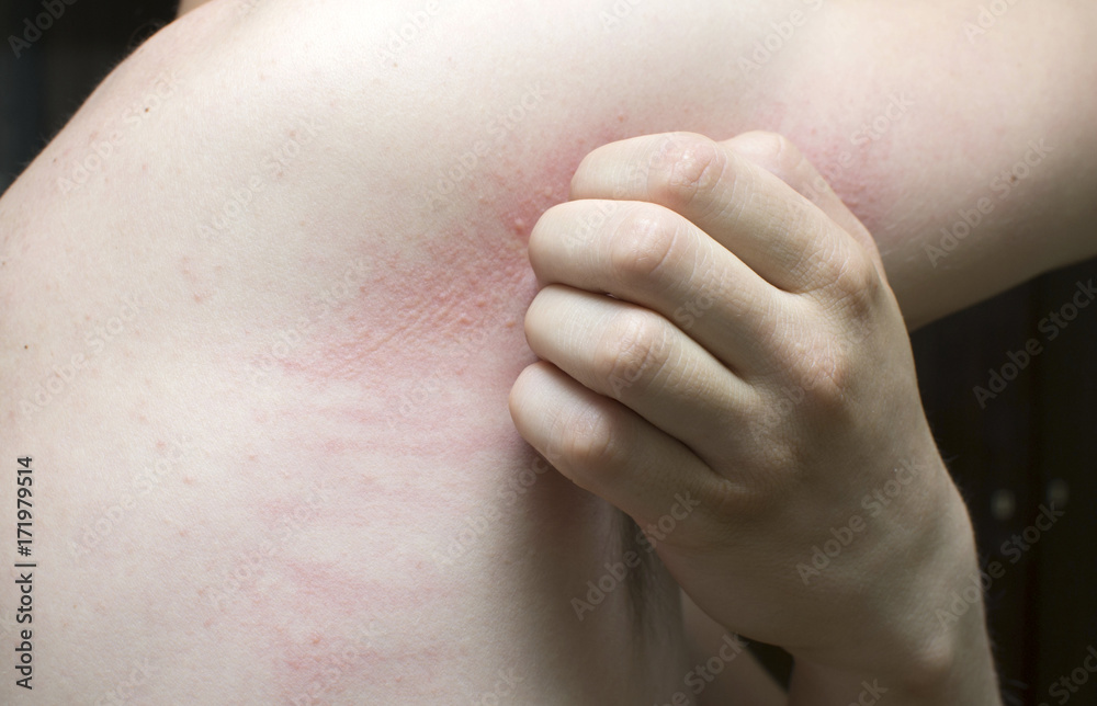 man with symptoms of itchy urticaria.