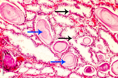 Prostate hyperplasia. Photomicrograph showing dilated glands, papillary projections inside the glands lumen, black arrows , cystic dilatation with accumulation of secretory material, blue arrows photo