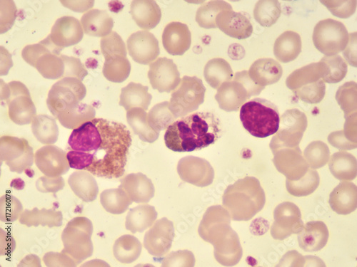 White blood cells in blood smear, analyze by microscope