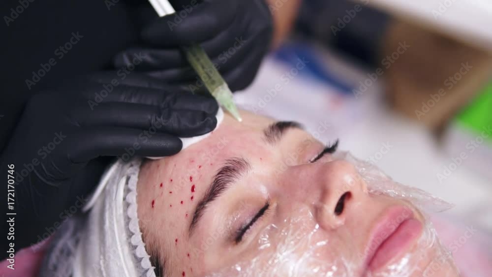Young woman is lying on the couch while professional comsetologist in gloves is making multiple injections in woman's forehead during mesotherapy. Biorevitalization and face lifting Young woman is lying on the couch while professional comsetologist in gloves is making multiple injections in woman's forehead during mesotherapy. Biorevitalization and face lifting