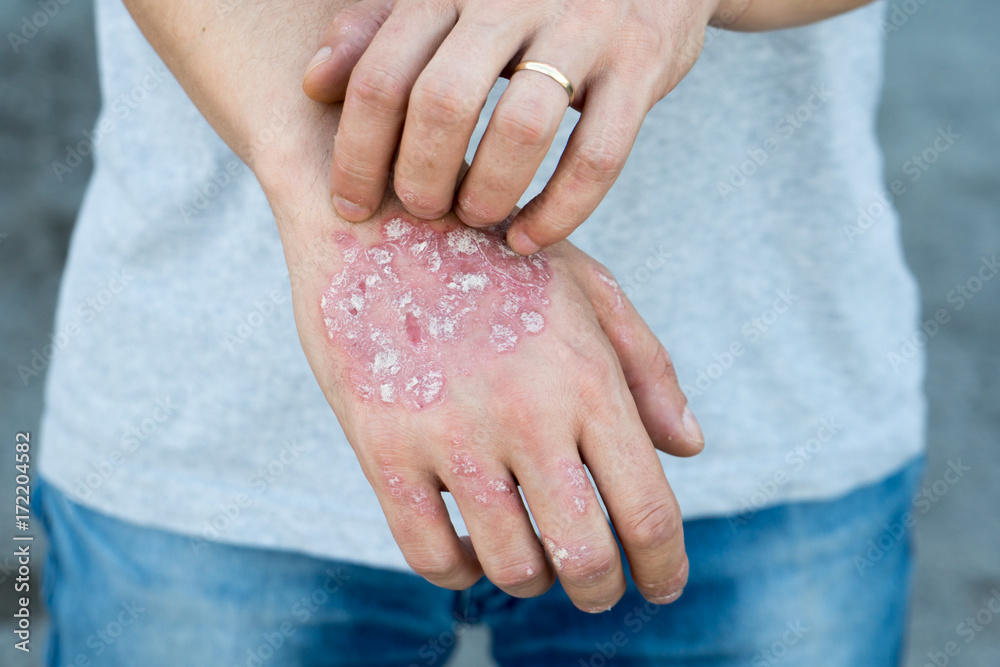 Man scratch oneself, dry flaky skin on hand with psoriasis vulgaris, eczema and other skin
