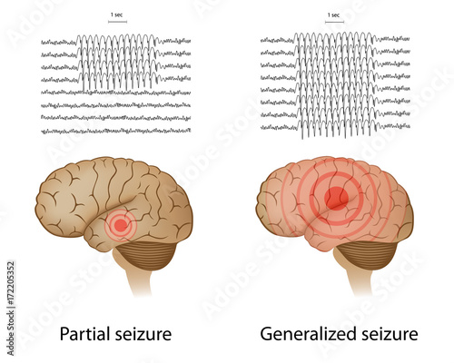EEG in partial and generalized epilepsy