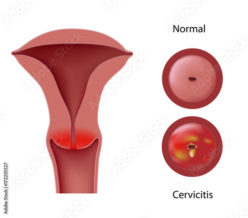 Cervicitis - inflammation of the cervix  photo