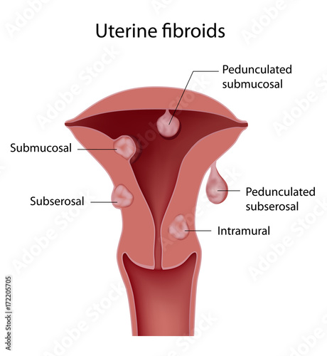 Uterine fibroid photo