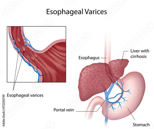 Esophageal varices photo