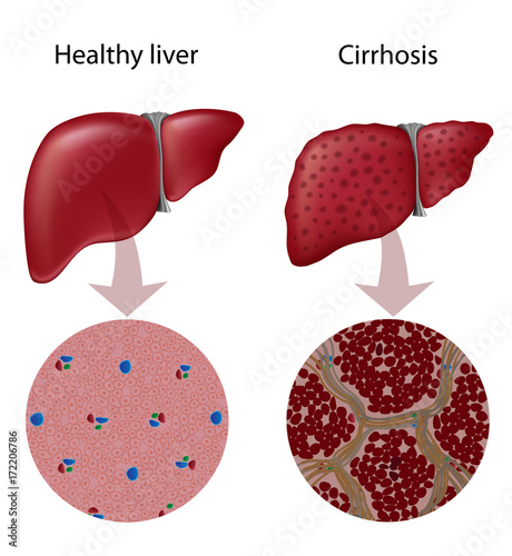 Liver cirrhosis 