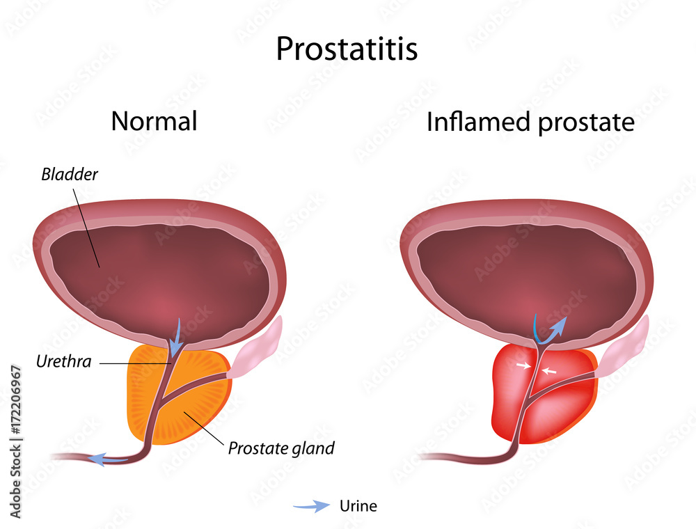 a vér a prostatitis hogyan vásárolhat egy tablettát a prosztatitisből