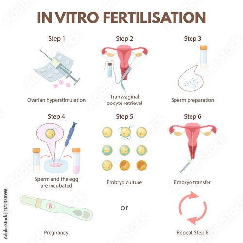 In vitro fertilization