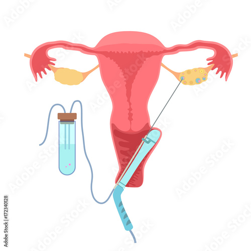 In vitro fertilisation
