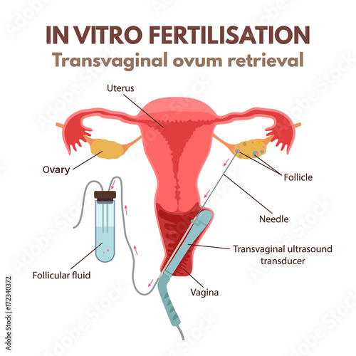 In vitro fertilisation