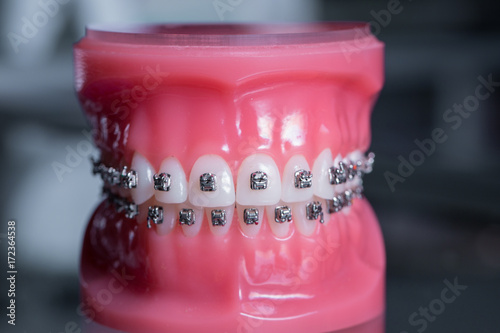tooth model with metal wired dental braces photo