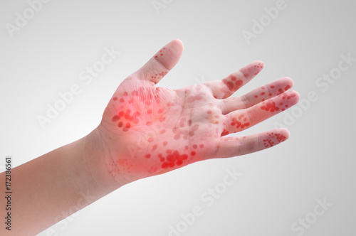 Viral Diseases - Hand Infected - Hand foot and mouth disease HFMD photo