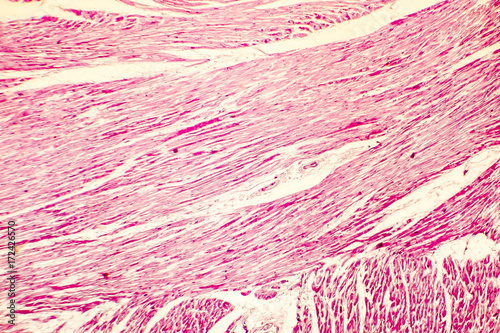 Heart hypertrophy. Photomicrograph showing hypertrophic myocardium with thick muscle fibers and enlarged and dark nuclei photo