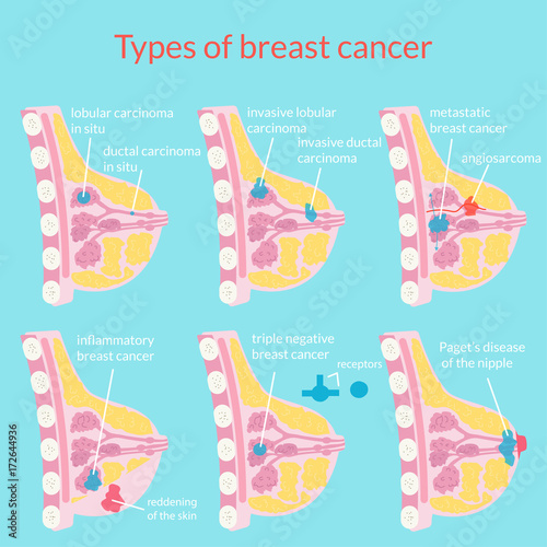 ypes of breast cancer. Medical poster. Vector illustration.