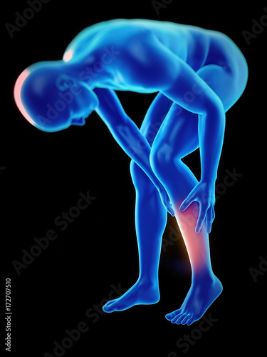 medically accurate 3d rendering of a guy with a painful leg