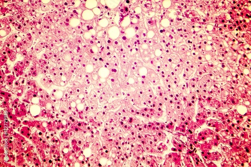 Fatty liver, liver steatosis. Photomicrograph showing large vacuoles of triglyceride fat accumulated inside liver cells, it occurs in alcohol overuse, under action of toxins, in diabetes