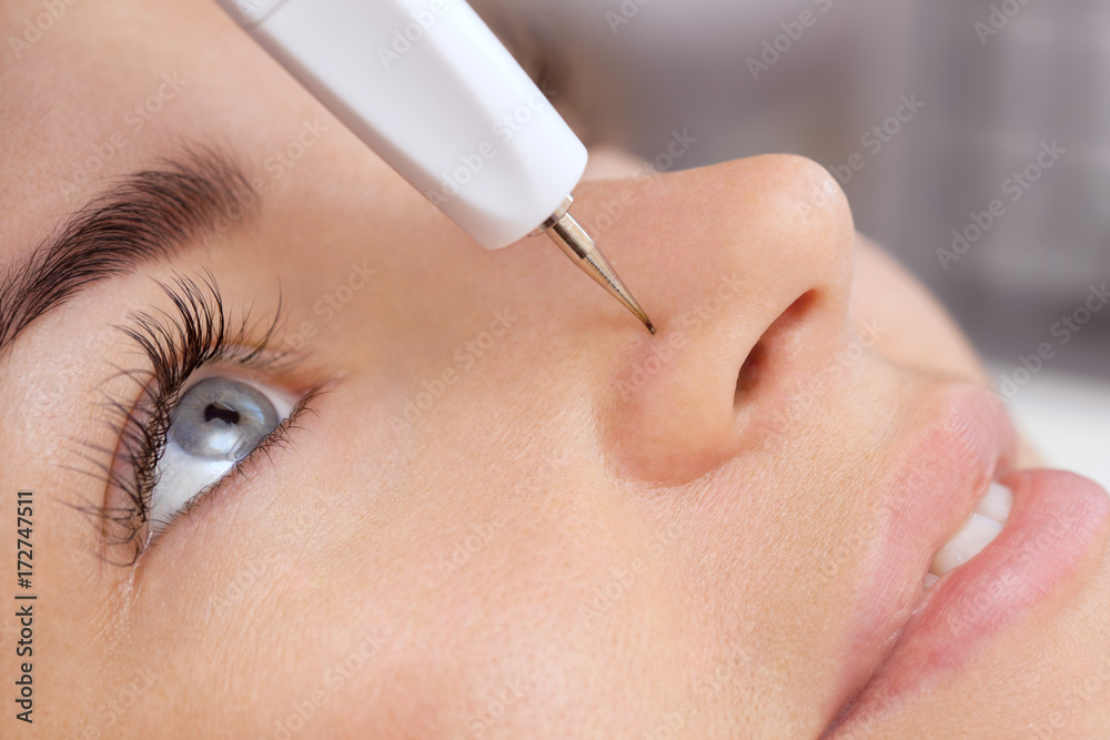 The cosmetologist makes the procedure treatment of Couperose of the facial skin of a beautiful, young woman in a beauty salon.Cosmetology and professional skin care.