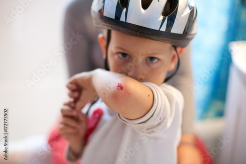 Boy shows off his scraped elbow