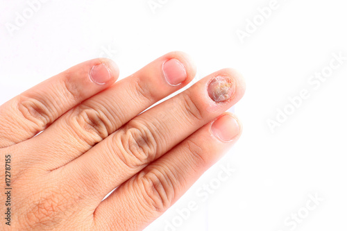 Obraz na plátně Fungus Infection on Nails Hand, Finger with onychomycosis, Fungal infection on nails handisolated on white background