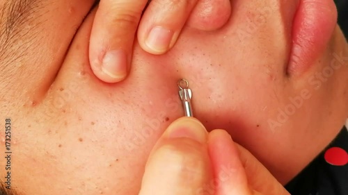 Torture and pain suffer from squeezing pimple blackheads from the face of a teenager with a blackhead popper

