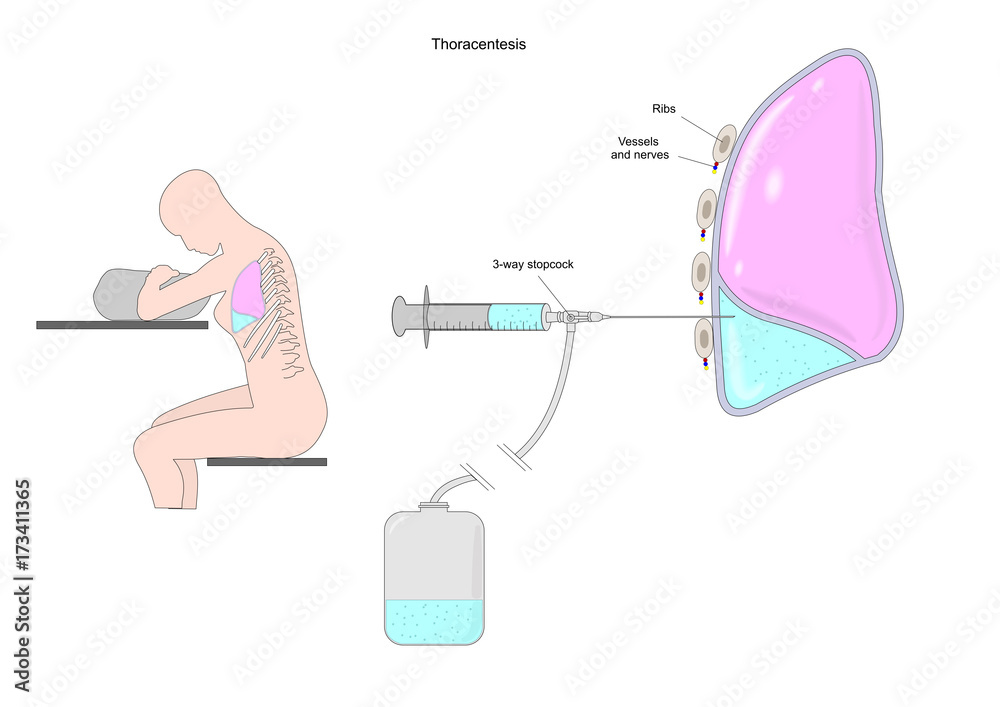 thoracentesis, or thoracocentesis, a surgery procedure to remove fluid