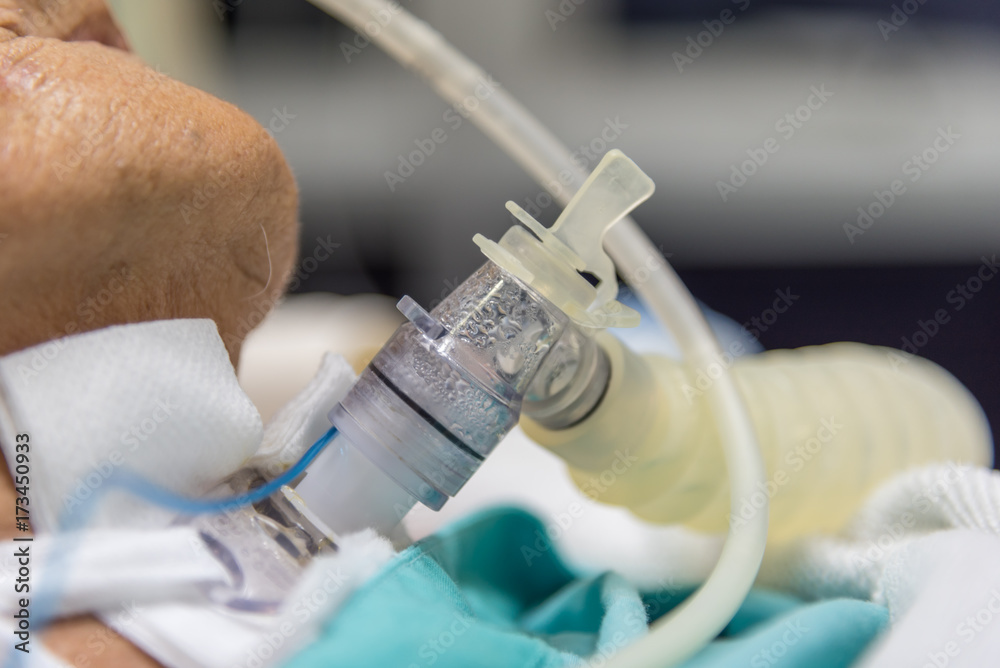 Patient do tracheostomy and ventilator in hospital Photos Adobe Stock
