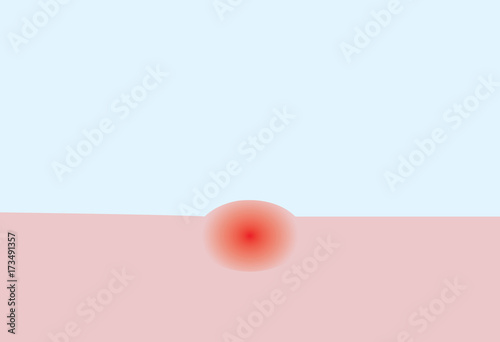 vector of allegic itchy red spot bump on the skin