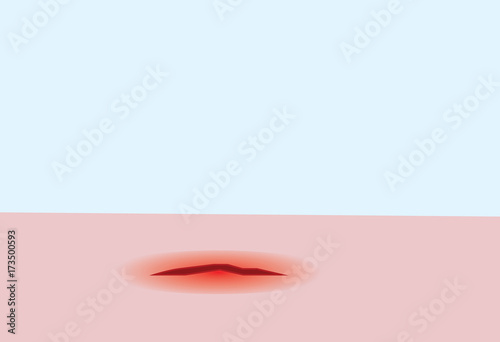 vector of bleeding wound on the skin