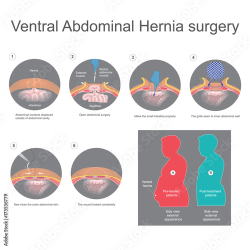 Ventral hernia is a bulge of tissues through an opening of weakness within your abdominal wall muscles. Info graphic vector.