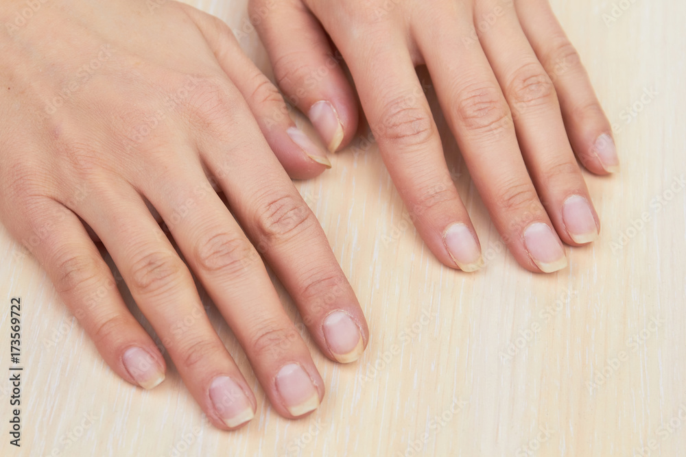 Woman hands after removing gel. Female hands ready for treatment and manicure on salon table. Skin therapy and nails care. Woman hands after removing gel. Female hands ready for treatment and manicure on salon table. Skin therapy and nails care.