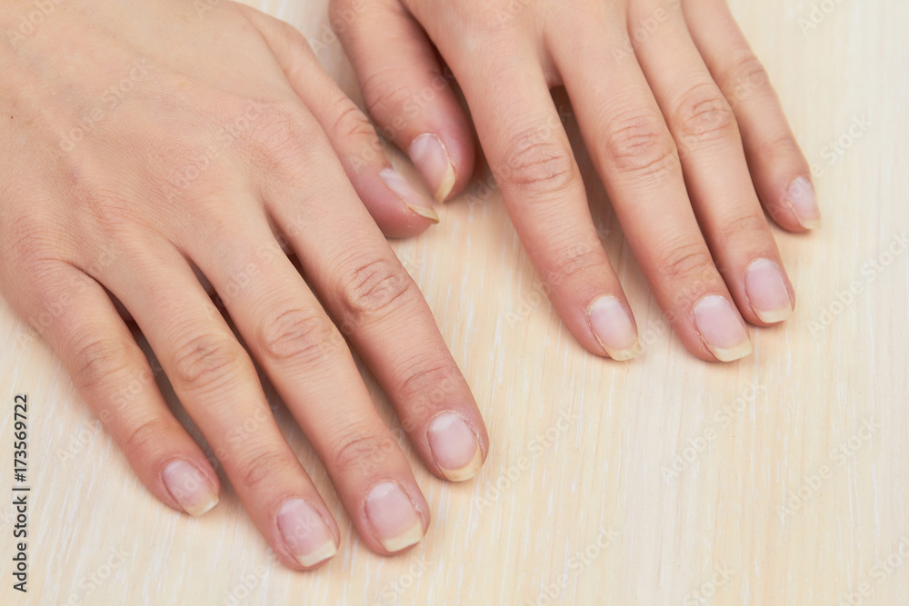 Woman hands after removing gel. Female hands ready for treatment and manicure on salon table. Skin therapy and nails care.