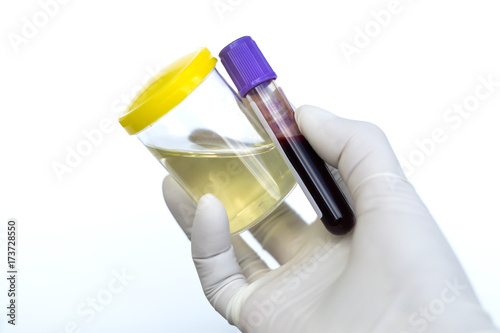 фотографія blood test with urine sample test,Doctor holding a container in hand, isolated on white background, Urine sample test