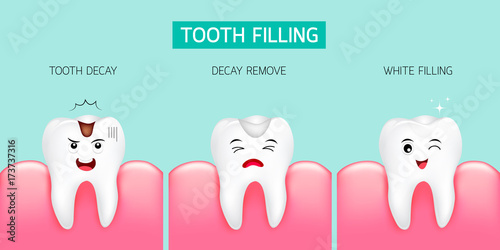 Step of tooth filling. Tooth decay, decay remove and white filling. Cute cartoon design, illustration isolated on green background. Dental care concept.