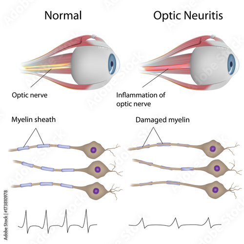 Optic neuritis, labeled