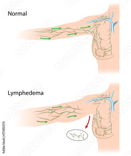 Lymphedema