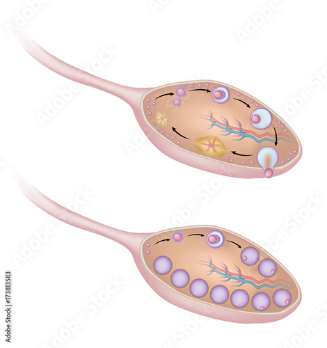 Polycystic ovary syndrome, unlabeled.  photo