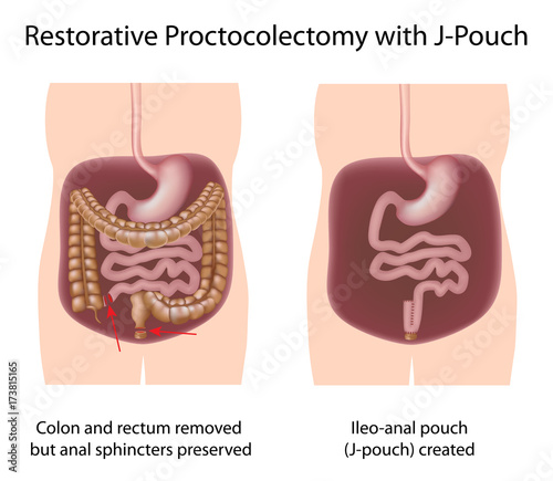 Restorative proctocolectomy procedure with J-pouch photo