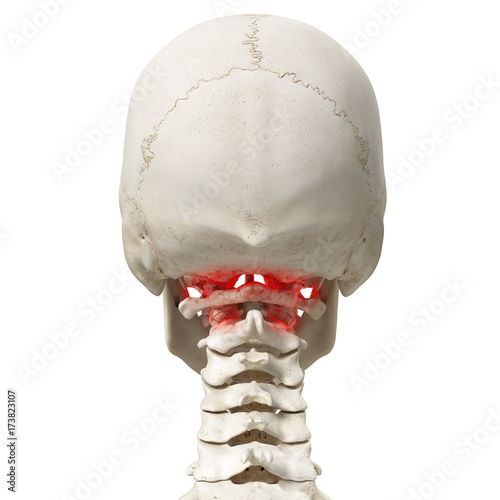 3d rendered medically accurate illustration of an arthritic atlas photo