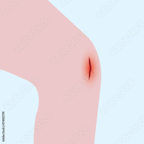 vector of bleeding wound on the knee