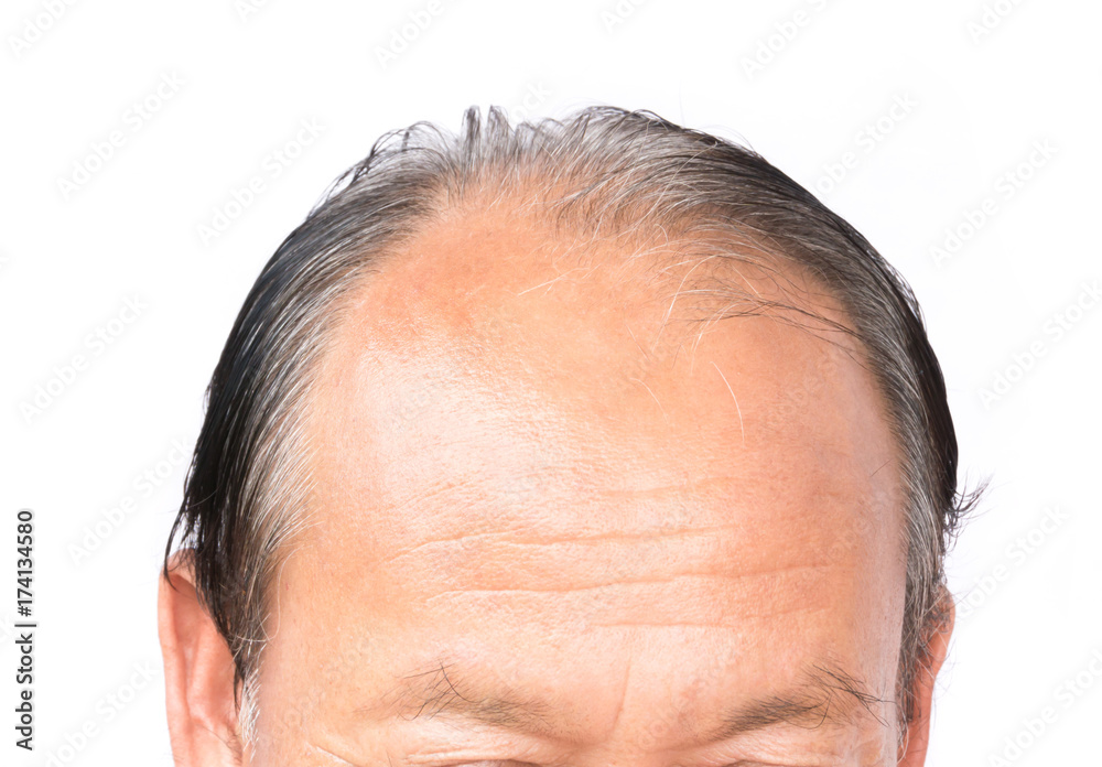 Closeup old man serious hair loss problem and gray for health care shampoo and beauty product concept Closeup old man serious hair loss problem and gray for health care shampoo and beauty product concept